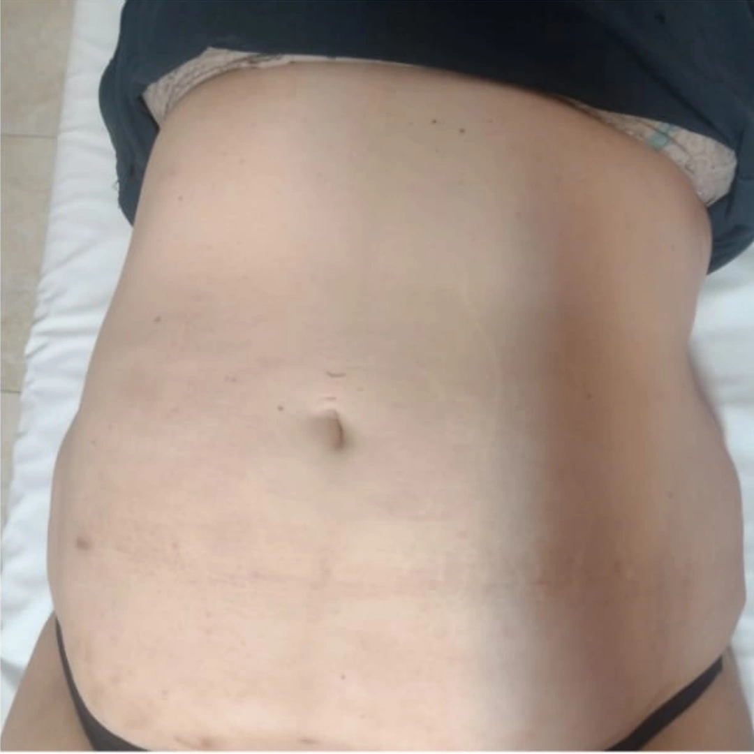 Antes — abdomen