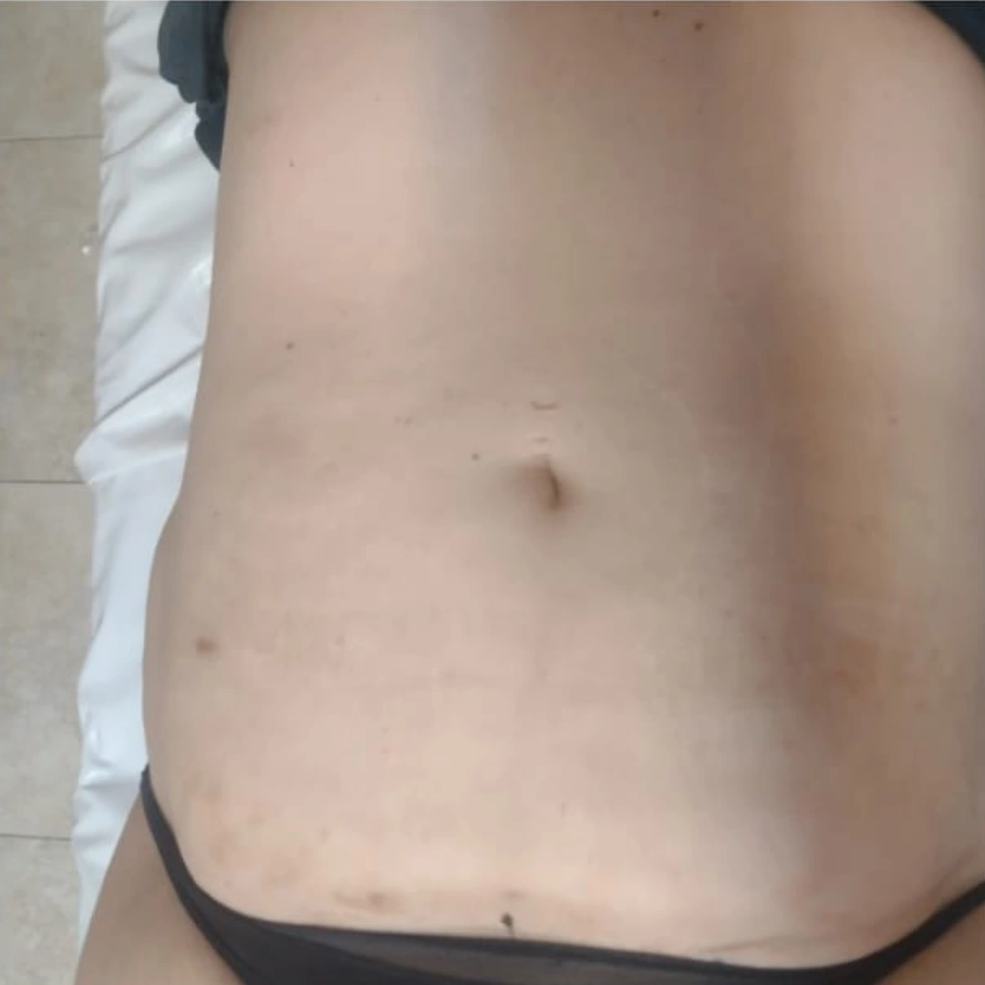 Después — abdomen
